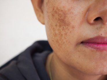Cuidado con lunares, manchas y lesiones sospechosas que pueden ser síntomas de cáncer a la piel