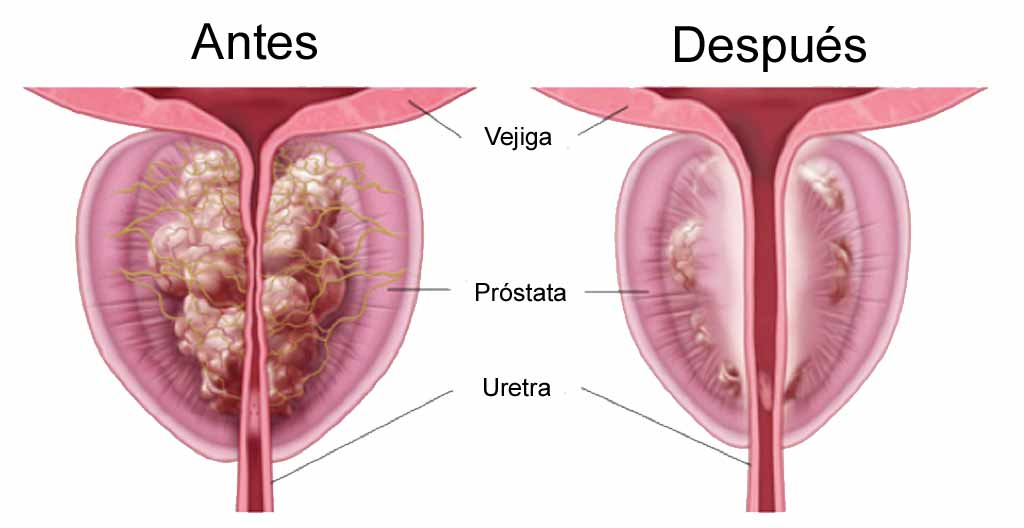 Antes y después -vapor-de-agua-prostata